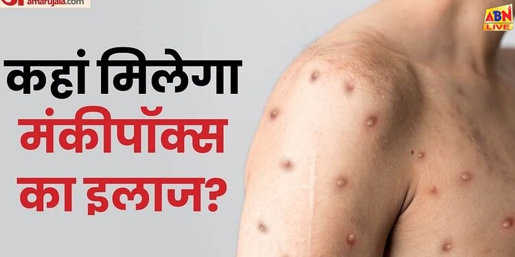 Mpox: जान लीजिए दिल्ली के किन अस्पतालों में मिलेगा मंकीपॉक्स का इलाज, लक्षण और बचाव भी जानें