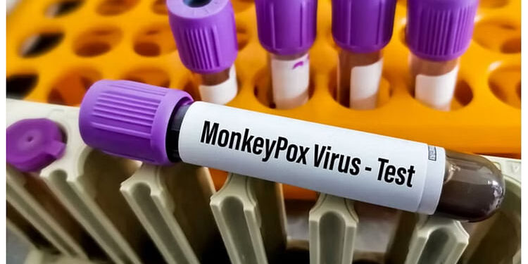 Monkeypox: भारत में मंकीपॉक्स के संदिग्ध मामले ने बढ़ाई चिंता, कैसे रहें सुरक्षित? संक्रमण हो जाए तो क्या करें