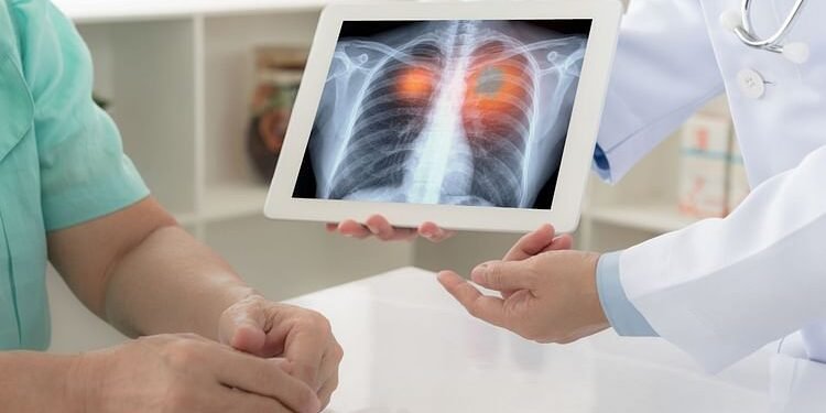 Lungs Test: घर बैठे जानिए कितने स्वस्थ हैं आपके फेफड़े? इस टेस्ट से मिनटों में मिलेगा रिजल्ट वो भी बिल्कुल फ्री