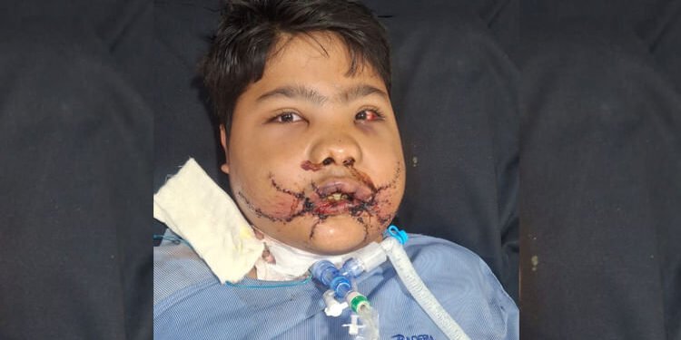 MP News: बम फटने से नाबालिग के चेहरे पर 108 फ्रैक्चर, डॉक्टरों ने ढाई घंटे के ऑपरेशन से लौटाई ज़िंदगी